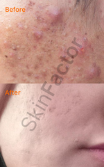 Acne Control Kit