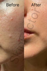 Anti Acne Kit Before After