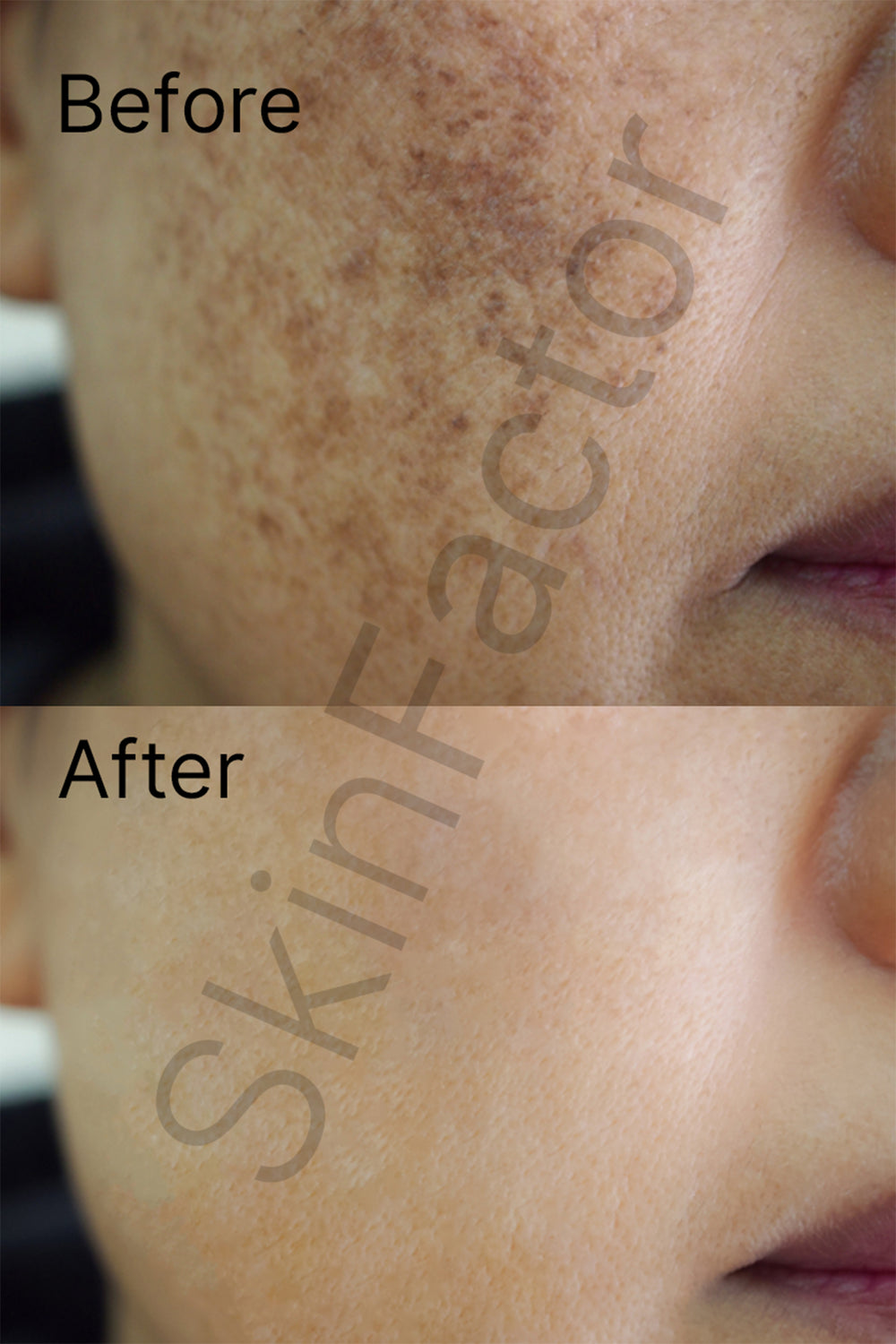 Kojic Acid 2% Serum Before after