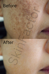 Kojic Acid 2% Serum Before after