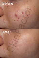 Niacinamide 10% Serum Before After