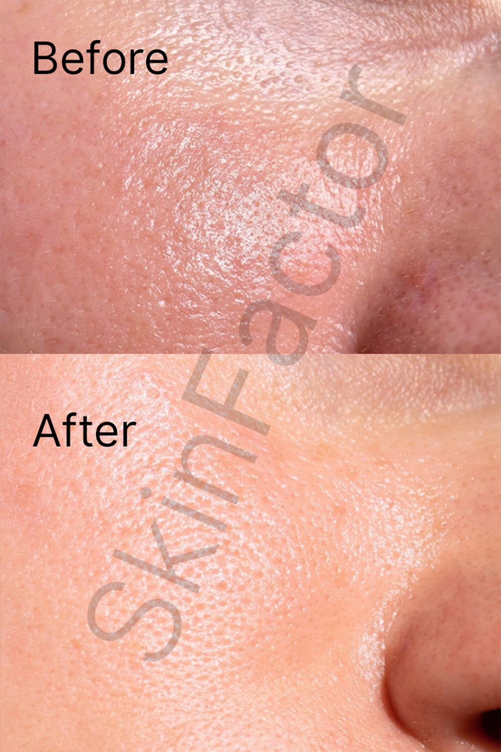 Oil Control Skincare Kit Before After