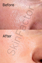 Oil Control Skincare Kit Before After