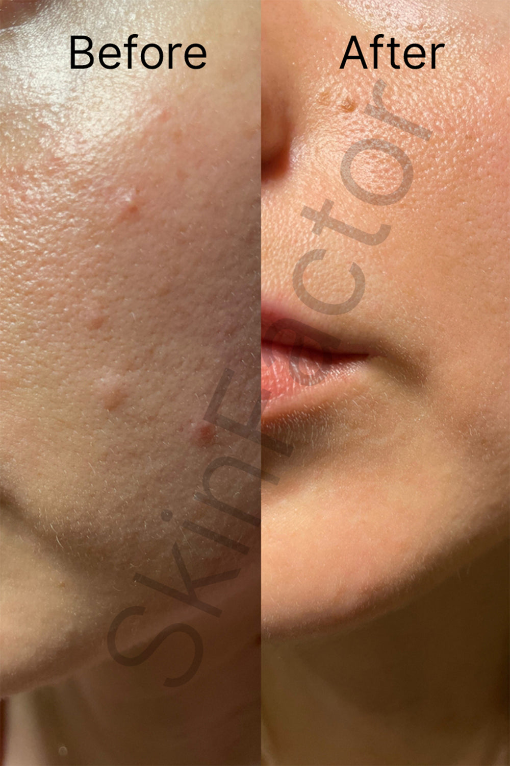 Salicylic Acid Anti Acne Duo Before After