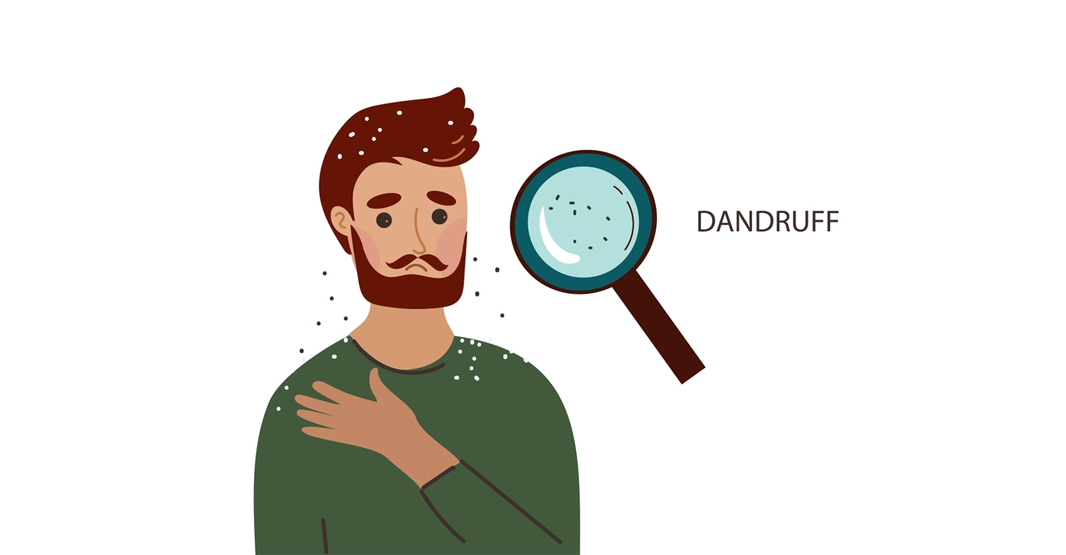 Dandruff Myths Debunked