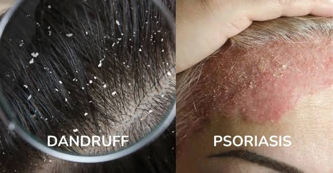 Dandruff vs Dry Scalp vs Scalp Psoriasis