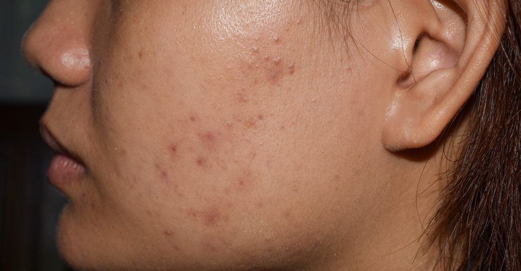 How to Fade Acne Marks and Dark Spots After Breakouts in Pakistan
