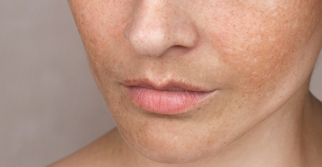 How to Fade Pigmentation Before Your Wedding