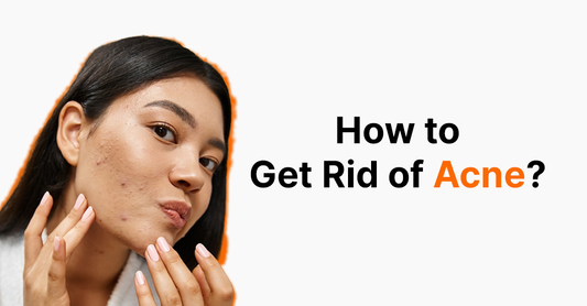 How to Get Rid of Acne in Pakistan: Complete Guide (2026)