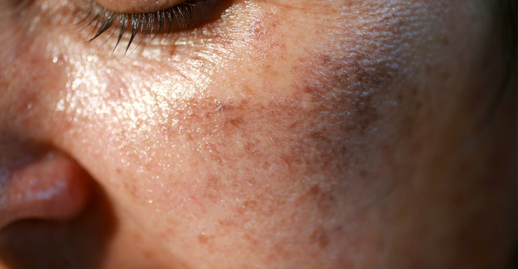 How to Prevent Sun Damage in Pakistan