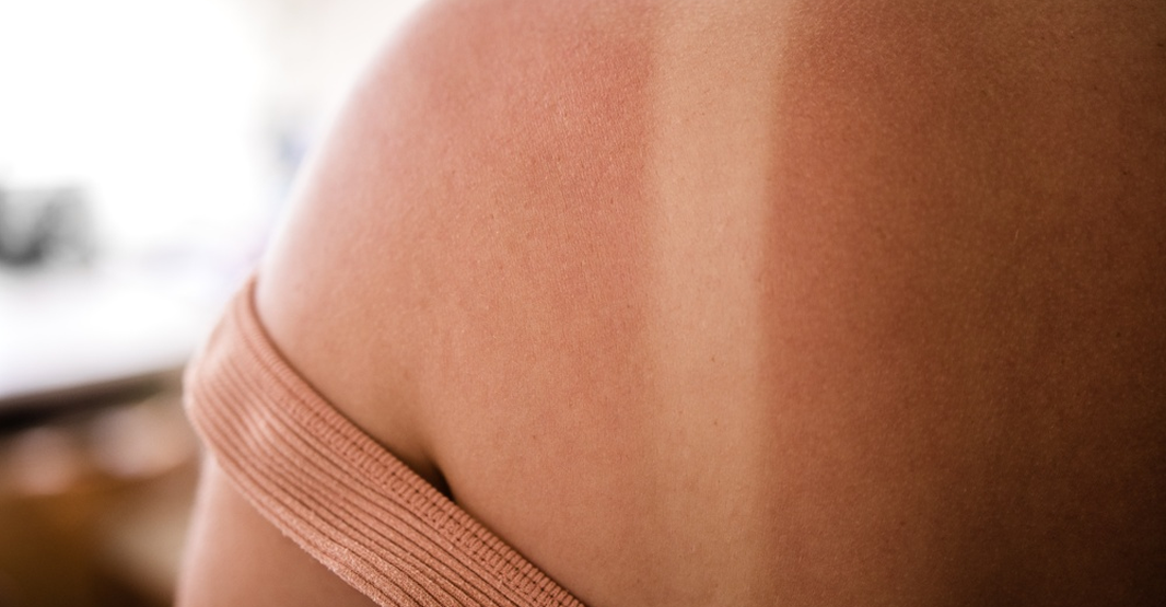 How to Remove Body Tanning and Uneven Skin Tone in Pakistan