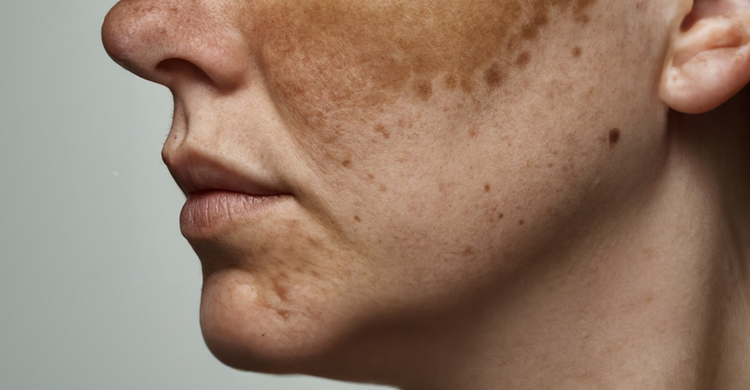 How to Remove Dark Spots in Pakistan: Complete Guide (2026)