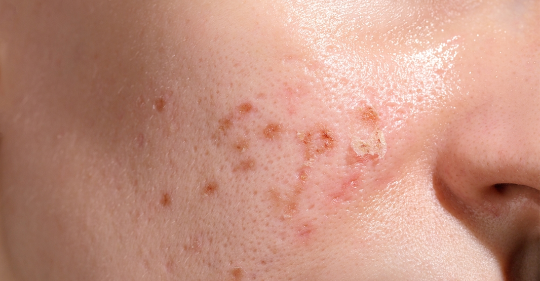How to Repair UV Damaged Skin in Pakistan (2026)