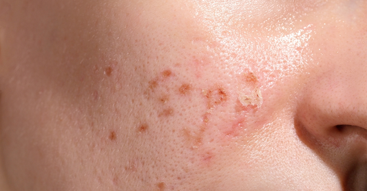 How to Repair UV Damaged Skin in Pakistan (2026)