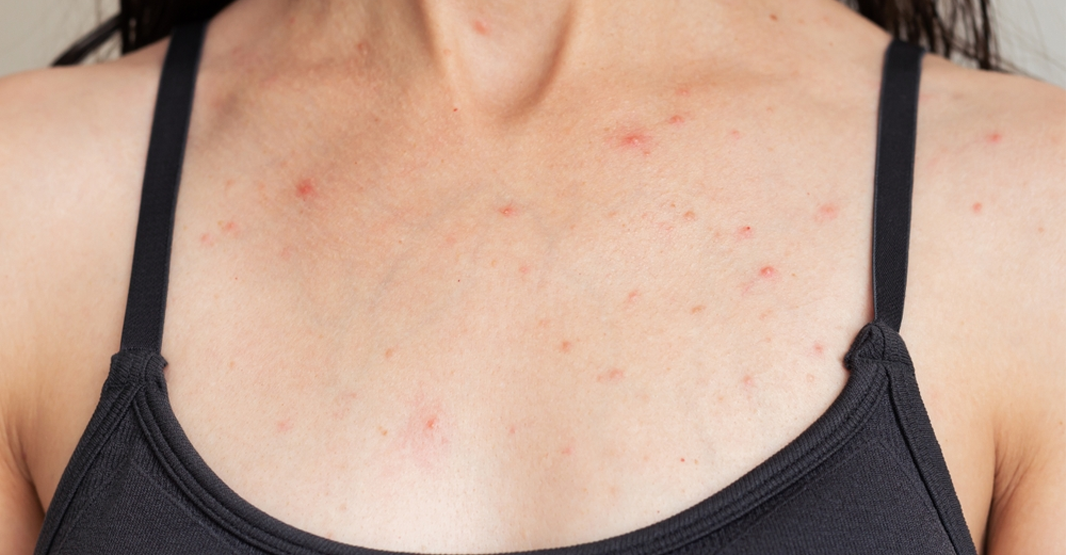 How to Treat Body Acne in Pakistan: Complete Guide (2026)