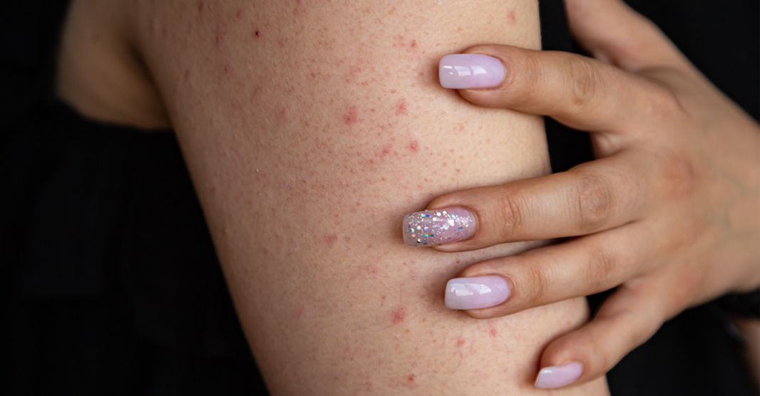 Keratosis Pilaris in Pakistan