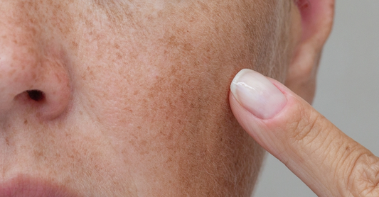 Kojic Acid for Dark Spots in Pakistan: Complete Guide