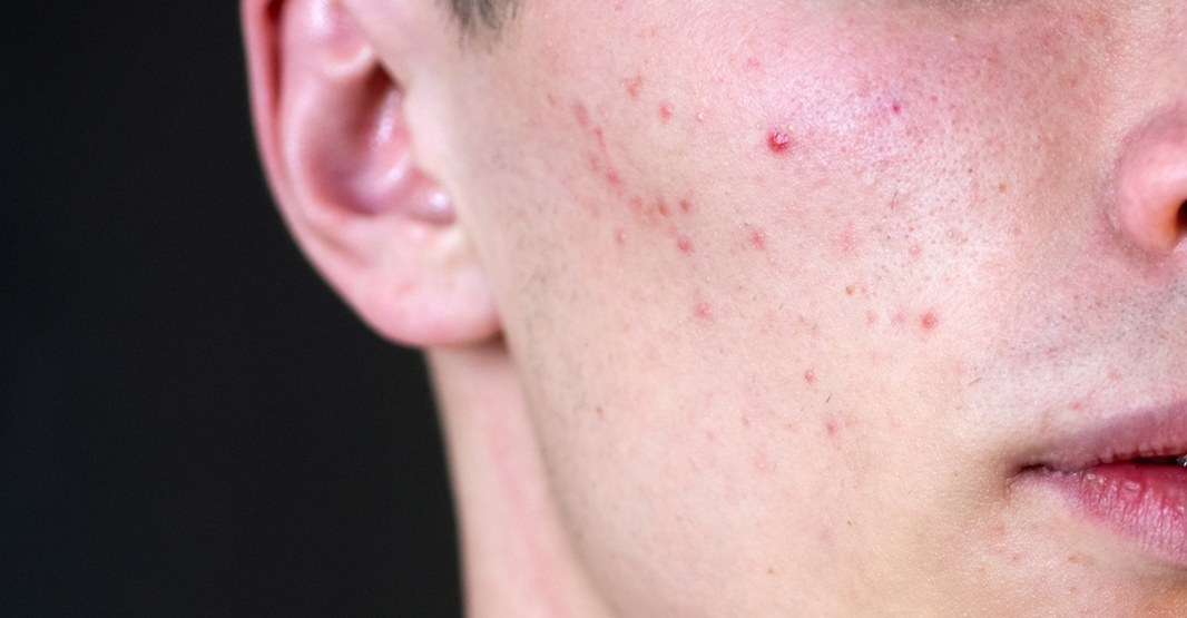 Men's Acne