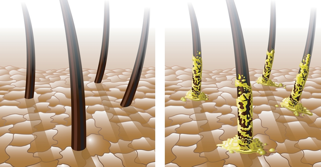 Oily Scalp Dandruff vs Dry Scalp Dandruff