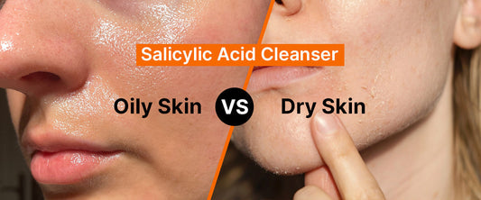 Salicylic Acid Cleanser for Oily Skin vs Dry Skin – Key Differences