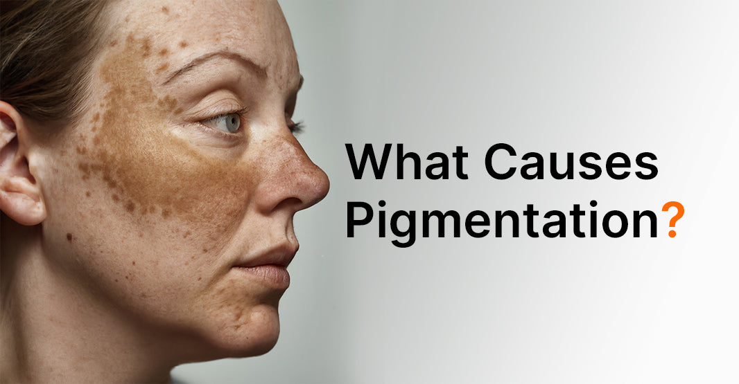 What Causes Pigmentation on Pakistani Skin?