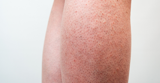 What Causes Strawberry Legs in Pakistan and How to Treat Them