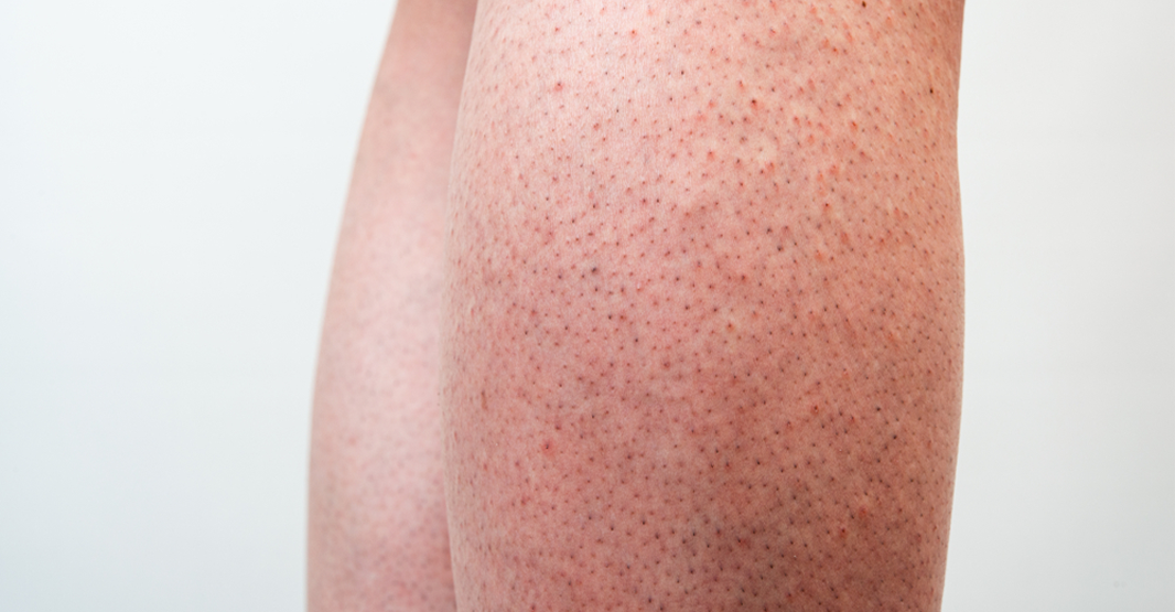 What Causes Strawberry Legs in Pakistan and How to Treat Them