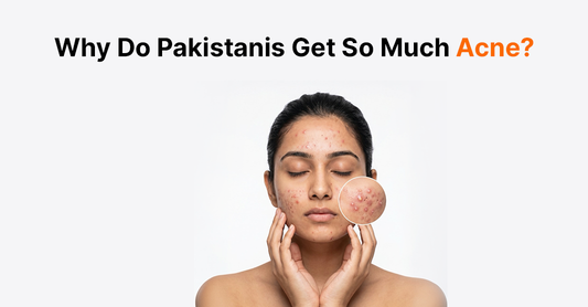 Why Do Pakistanis Get So Much Acne? Climate, Hard Water, and Heat