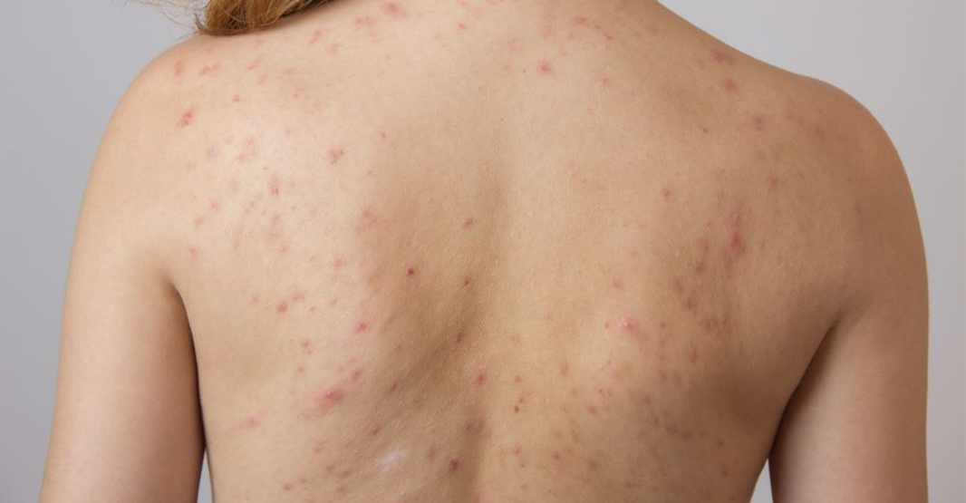 Why Pakistani Skin Gets Back Acne