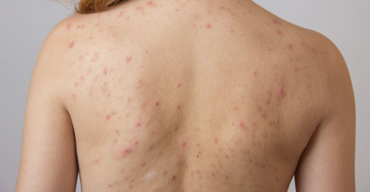 Why Pakistani Skin Gets Back Acne