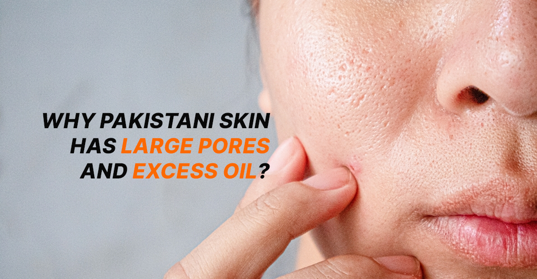 Why Pakistani Skin Has Large Pores and Excess Oil
