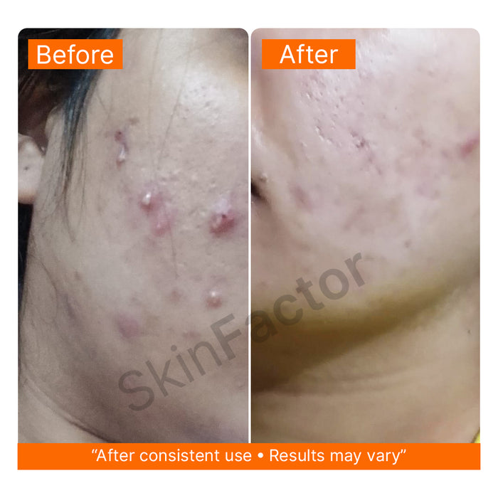 Before and after results