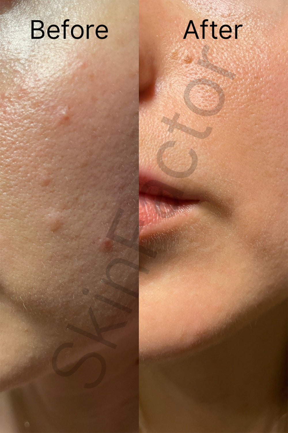 Salicylic Acid 2 Gel Cleanser Before After